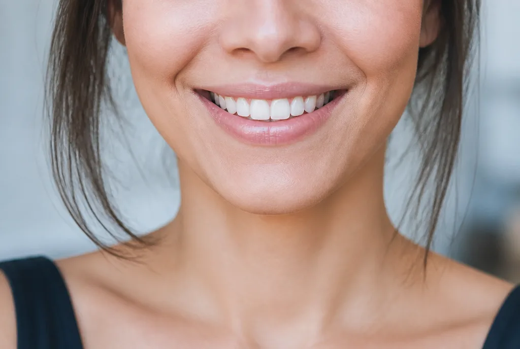 Smile Makeover