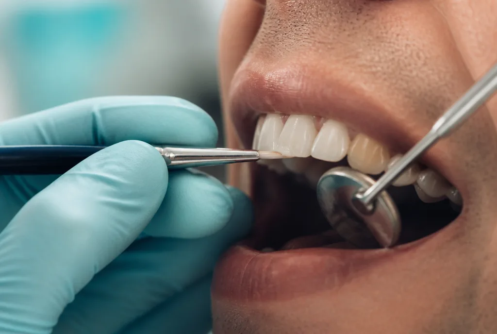 Composite Bonding